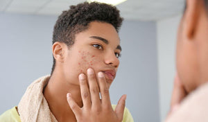 Teenager inspecting acne in the mirror, showcasing common skin challenges during adolescence.